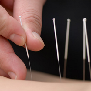 Acupuncture and Herbcare - Acupuncture