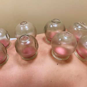 Acupuncture and Herbcare - Cupping